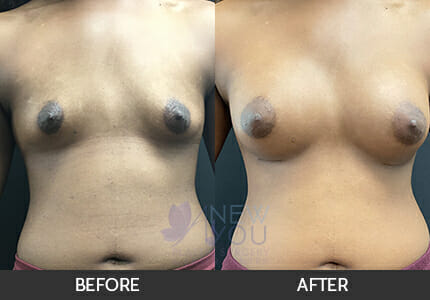 Breast Augmentation Gallery