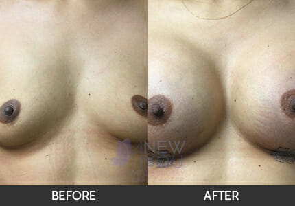 Breast Augmentation Gallery