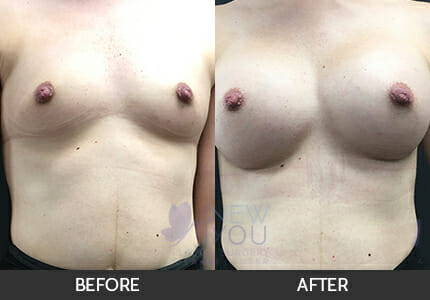 Breast Augmentation Gallery