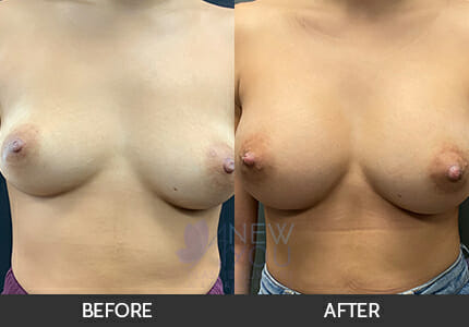 Breast Augmentation Gallery