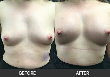 Breast Augmentation Gallery