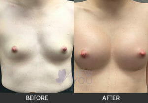 Breast Augmentation Before and After, Chicago, IL