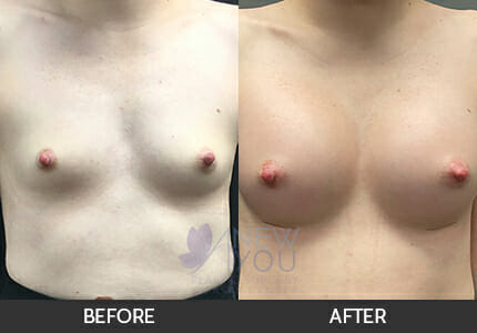 Breast Augmentation Gallery