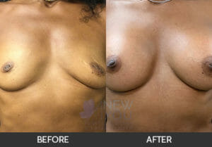 Breast Augmentation Before and After, Chicago, IL