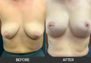 Breast Lift with Augmentation Before and After, Chicago, IL