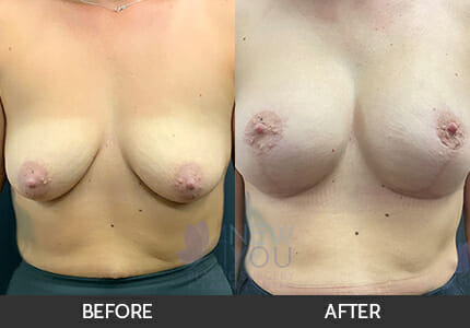 Breast Augmentation with Lift (Mastopexy) Gallery