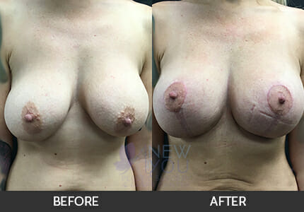 Breast Augmentation with Lift (Mastopexy) Gallery