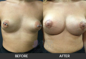 Breast Lift with Augmentation Before and After, Chicago, IL