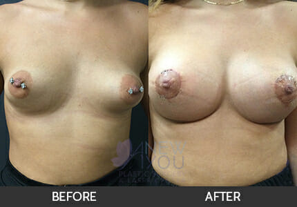 Breast Augmentation with Lift (Mastopexy) Gallery