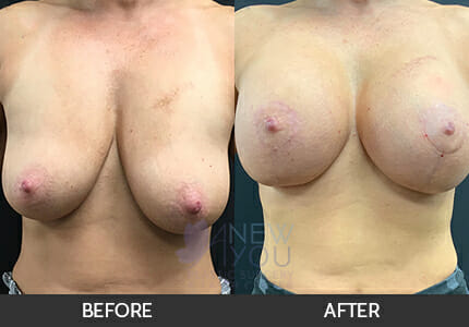 Breast Augmentation with Lift (Mastopexy) Gallery