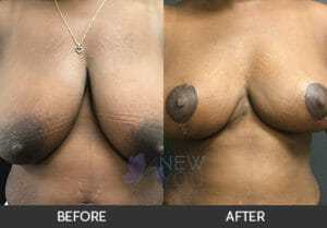 Breast Reduction Before and After, Chicago, IL