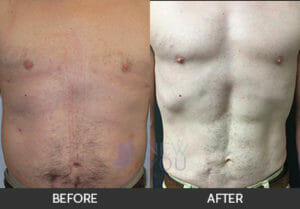 Gynecomastia Before and After, Chicago, IL