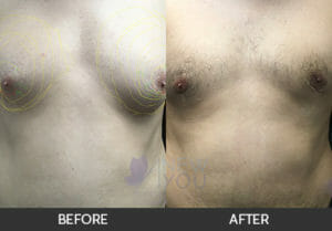 Gynecomastia Before and After, Chicago, IL