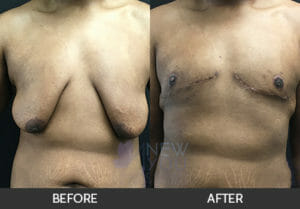 Gynecomastia Before and After, Chicago, IL