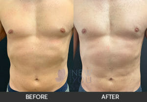 Male Liposuction Before and After, Chicago, IL