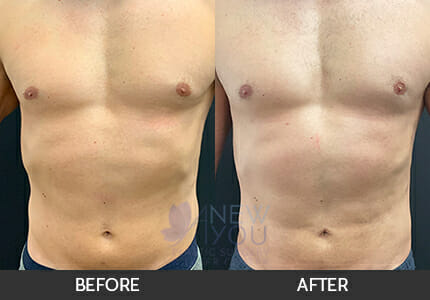 Male Liposuction Gallery