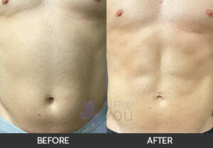 Male Liposuction Before and After, Chicago, IL