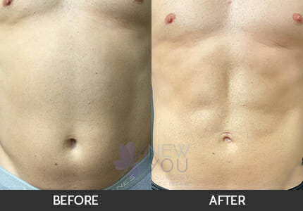 Male Liposuction Gallery