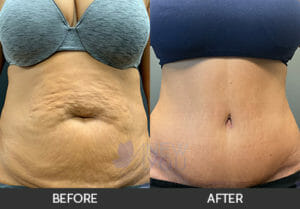 Tummy Tuck Before and After, Chicago, IL