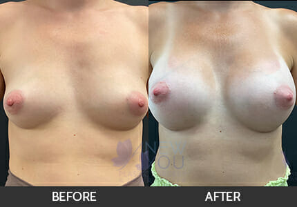 Breast Augmentation Gallery