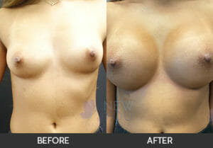 Breast Augmentation Before and After, Chicago, IL