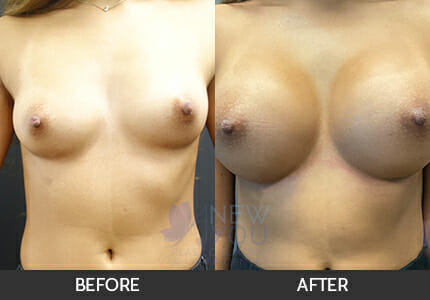 Breast Augmentation Gallery