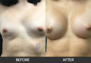 Breast Augmentation Before and After, Chicago, IL