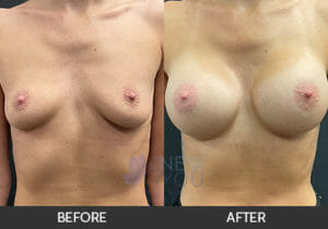 Breast Augmentation Before and After, Chicago, IL