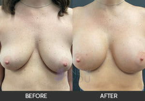 Breast Augmentation Before and After, Chicago, IL