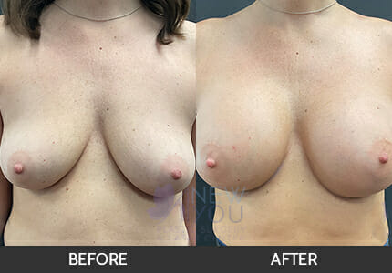 Breast Augmentation Gallery