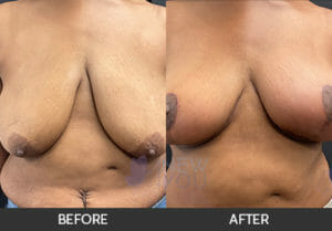 Breast Lift Gallery