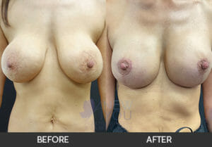 Breast Revision Before and After, Chicago, IL