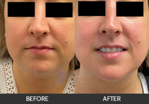 Liposuction Before and After, Chicago, IL