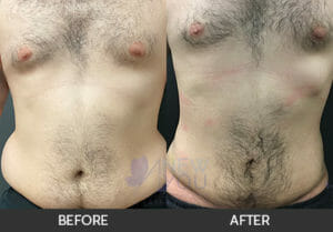 Liposuction Before and After, Chicago, IL