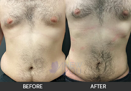 Liposuction Gallery