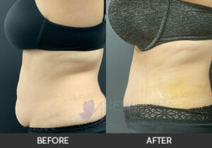 Tummy Tuck Before and After, Chicago, IL