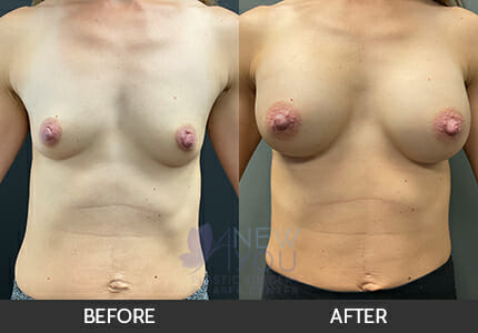 Breast Augmentation Gallery