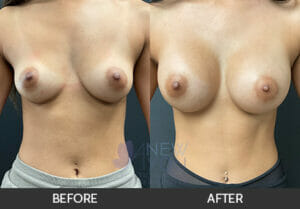 Breast Augmentation Before and After, Chicago, IL