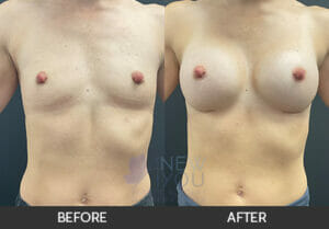 Breast Augmentation Before and After, Chicago, IL