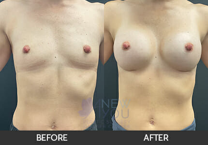 Breast Augmentation Gallery