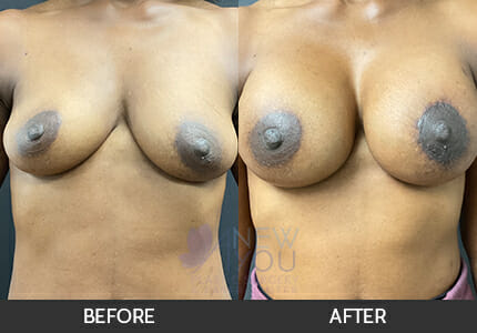 Breast Augmentation with Lift (Mastopexy) Gallery