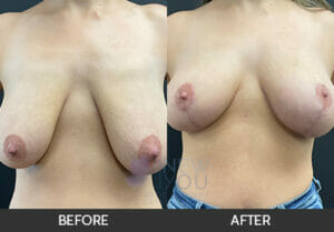 Breast Lift Before and After, Chicago, IL