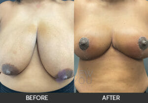 Breast Reduction Before and After, Chicago, IL