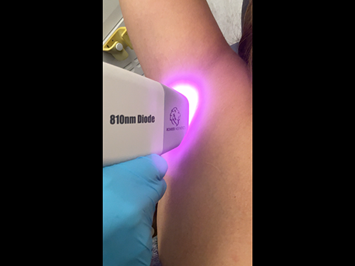 Laser hair removal on arm pit