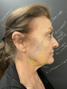 Deep Plane Facelift Example with Dr. Shah's Notes over the photo