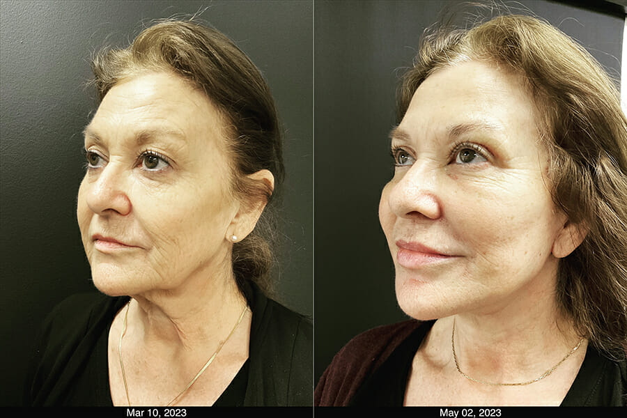 Before and After - Deep Plane Facelift