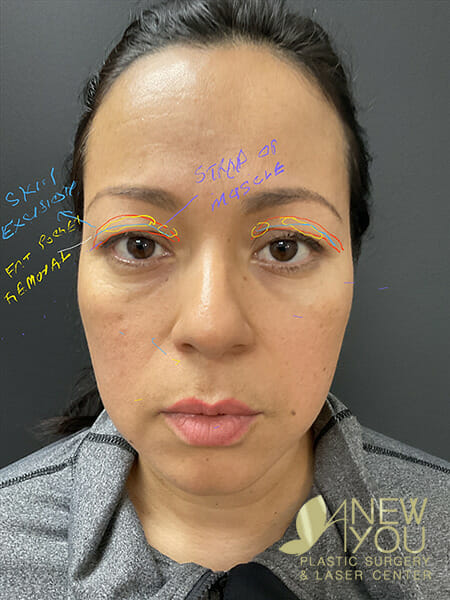 Do You Need Blepharoplasty Example