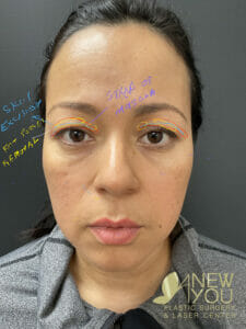 Blepharoplasty Example