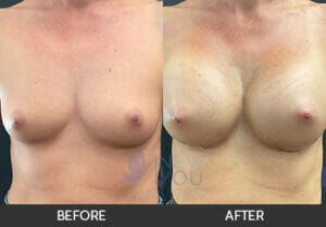 Breast Augmentation Before and After, Chicago, IL