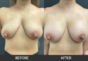 Breast Augmentation Before and After, Chicago, IL